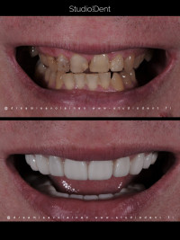 Hammaslaminaatti | Studiodent